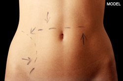 Woman's abdomen with dashed lines and arrows drawn across it