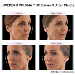 Woman's face before and after voluma injections