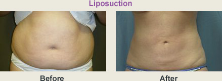 Belly before and after liposuction