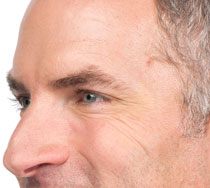 Man's profile showing crow's feet smoothed out