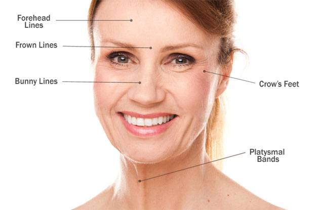 Woman's face with labels for injection points that are forehead lines, frown lines, bunny lines, crow's feet, platysmal bands