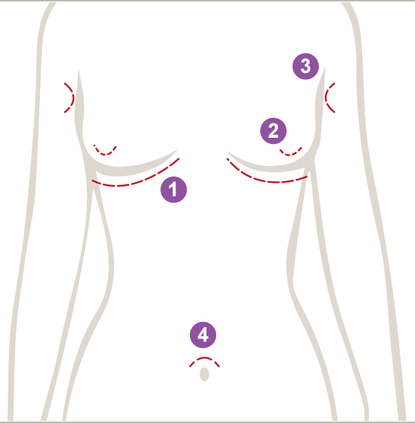 Breast augmentation incisions can be along the breast crease, around the areola, in the armpit, and in the navel.