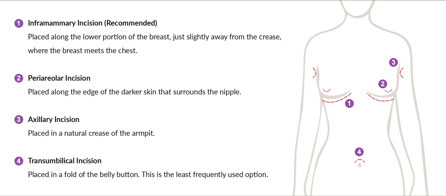 Breast augmentation incisions can be along the breast crease, around the areola, in the armpit, and in a fold of the navel.