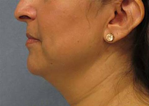 Woman's profile showing neck beginning at the end of her chin