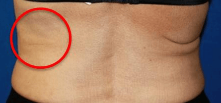 6 weeks after thermitight