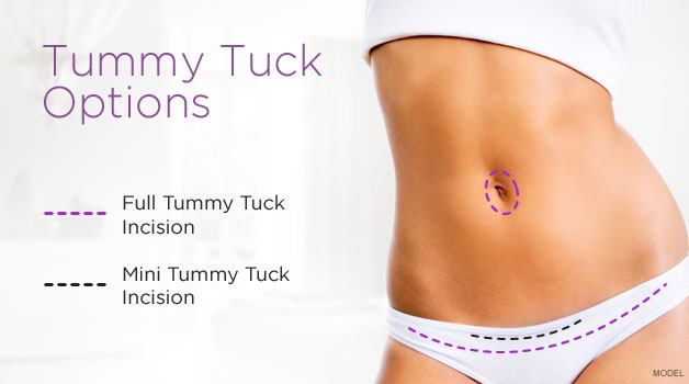 Full tummy tuck incision goes from hip to hip and around the belly button. Mini tummy tuck incision goes just above pubic bone.
