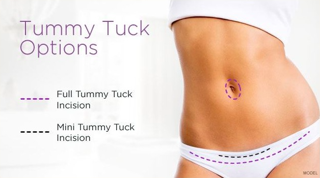 Tummy tuck incision options including a full tummy tuck incision or a mini tummy tuck incision