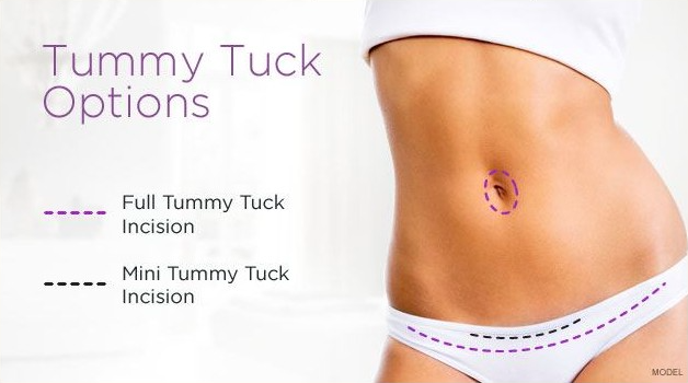 Photo of woman's midriff and dotted lines to show the location of tummy tuck and mini tummy tuck incisions