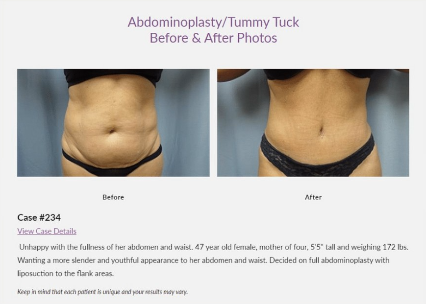 Belly Fat: What Can We Remove with a Tummy Tuck?