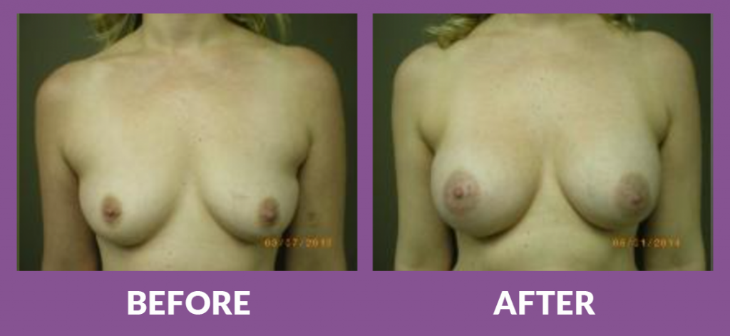Before and after breast augmentation scars