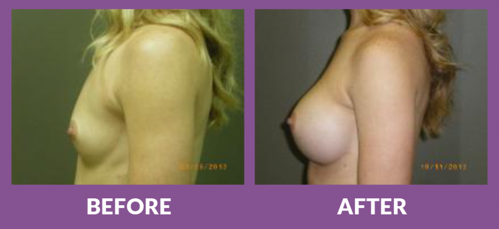 Breast augmentation before and after results