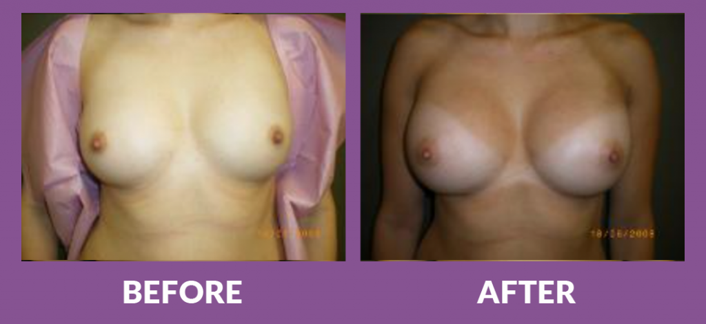 Before and after breast augmentation results from 34B to 34C