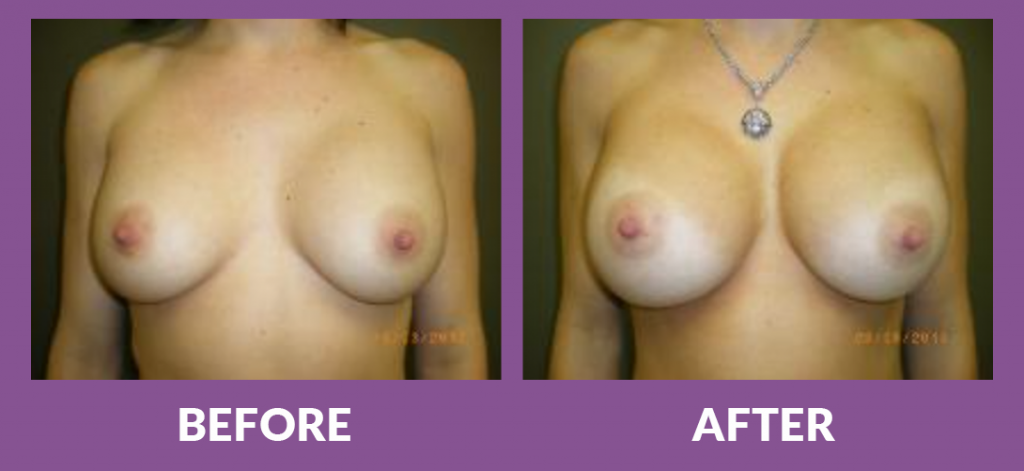 Before and after breast augmentation from a 34C to a 36DD