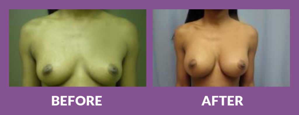 Before and after breast augmentation results